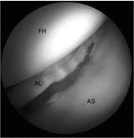 Labral tear as seen during surgery